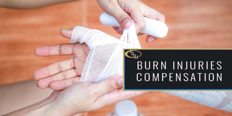 Burn Injuries- How You Could Get Compensated